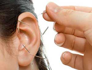 Auricular acupuncture
